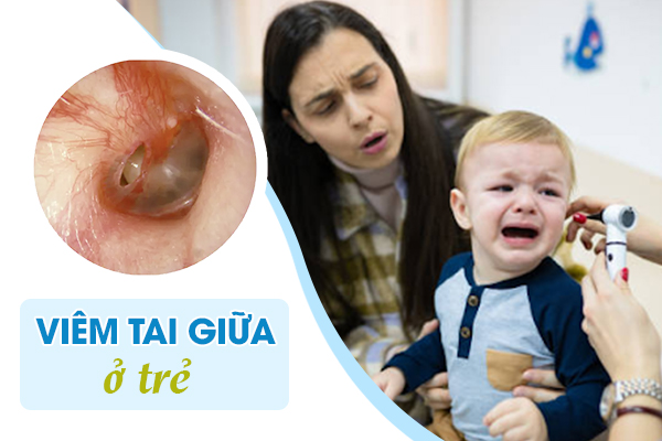 Viêm tai giữa ở trẻ em: Nguyên nhân, triệu chứng, chẩn đoán và cách điều trị