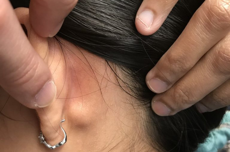 Nổi hạch sau tai do nguyên nhân gì?