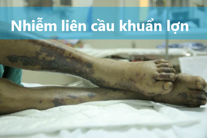 Nhiễm liên cầu khuẩn lợn nguy hiểm như thế nào?