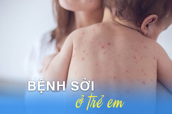 Bệnh sởi ở trẻ em: Nguyên nhân, triệu chứng, chẩn đoán, điều trị và phòng ngừa