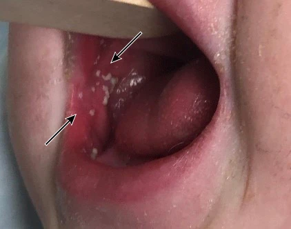 Hạt Koplik ở bệnh nhân sởi.