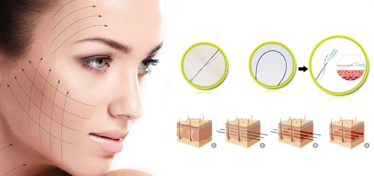 Căng chỉ da mặt sẽ giúp tạo lớp lưới giúp kéo căng phần da chảy xệ