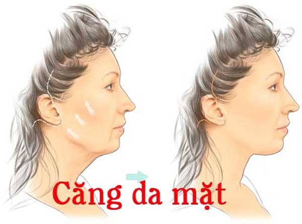 Tìm hiểu các phương pháp căng da mặt đang được áp dụng hiện nay