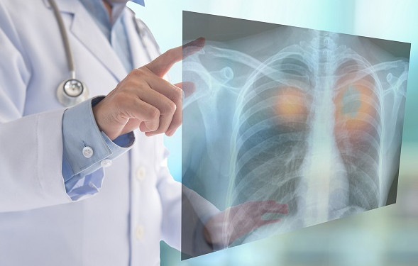 Nguyên nhân, dấu hiệu ung thư phổi và cách điều trị