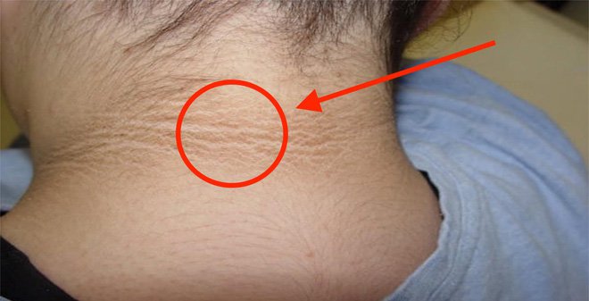 Bệnh gai đen: Nguyên nhân, cách điều trị và phòng ngừa