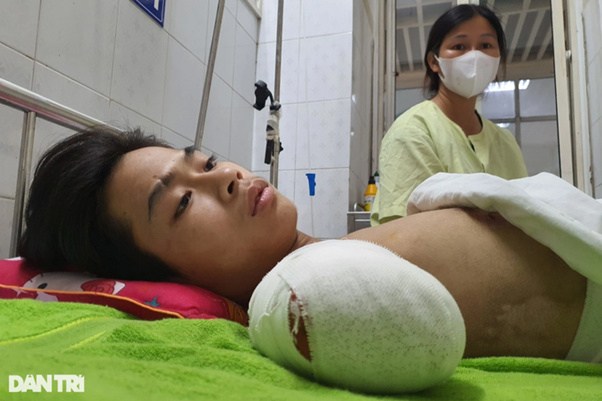 Cánh tay phải đã mất của cháu Hân sau ngày định mệnh