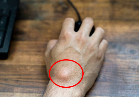 U mỡ dưới da là gì? Có nguy hiểm không?