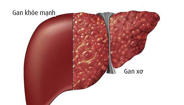 Gan nhiễm mỡ có thể dẫn đến xơ gan