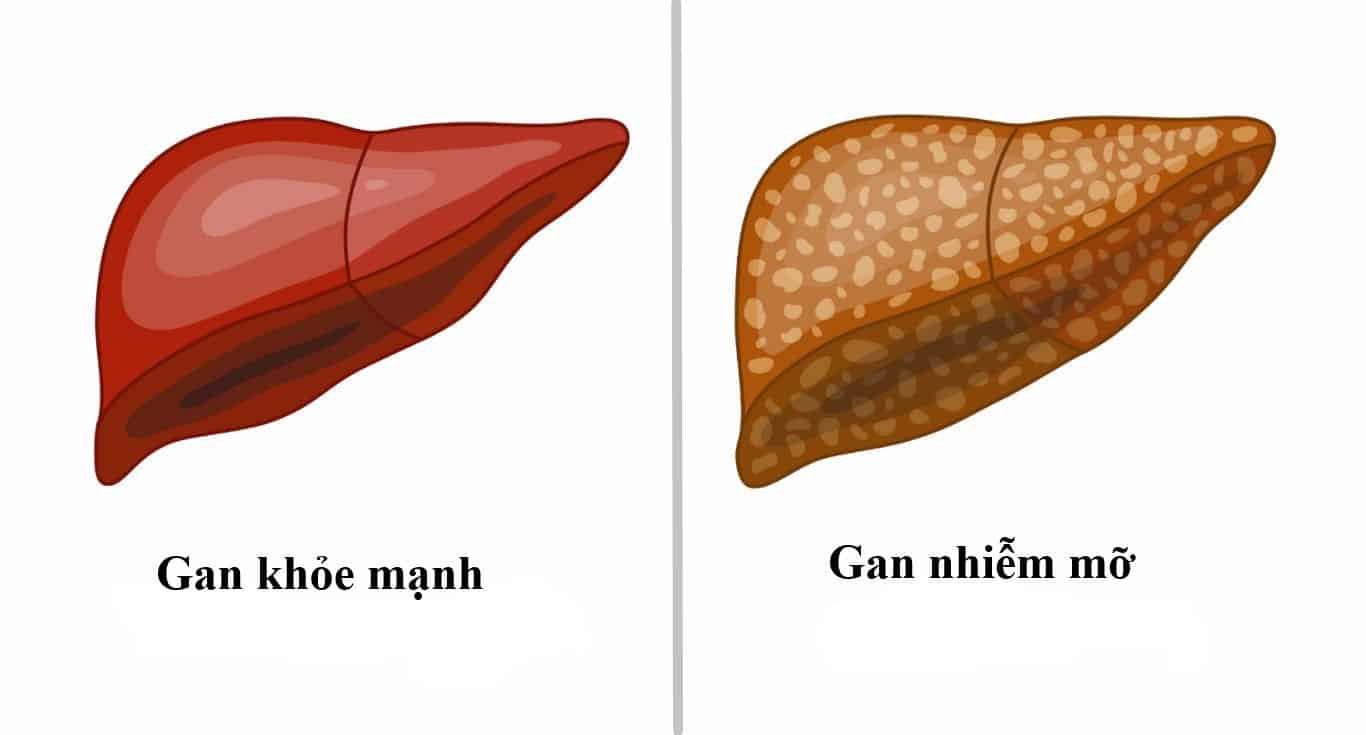 Người bệnh tiểu đường bị gan nhiễm mỡ nguy hiểm như thế nào?