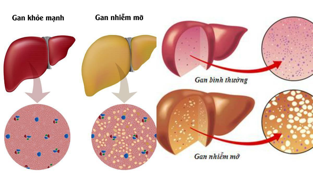 Tiểu đường sẽ làm tăng nguy cơ mắc gan nhiễm mỡ