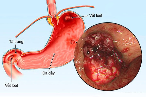 Nội soi giúp chẩn đoán viêm loét, polyp và ung thư dạ dày
