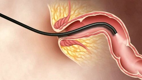  Nội soi hậu môn, trực tràng giúp phát hiện trĩ, sa trực tràng,...
