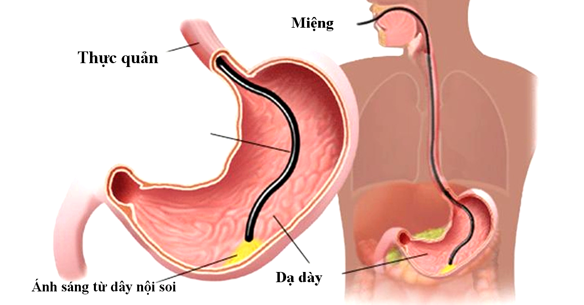 Nội soi tiêu hóa có thể phát hiện, chẩn đoán những bệnh lý nào?