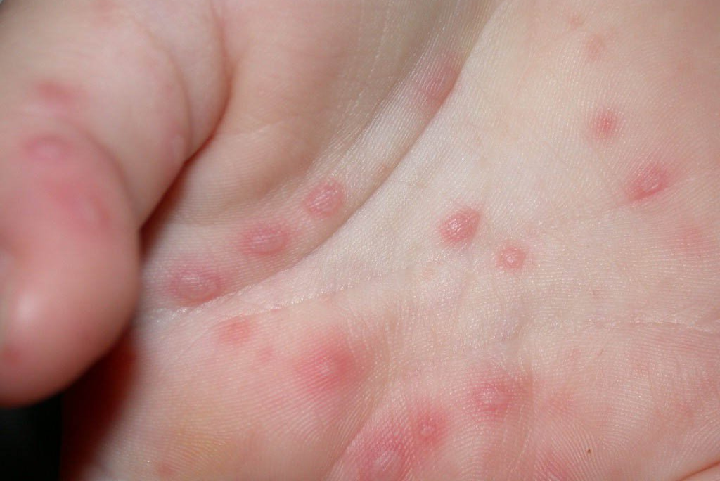 Bọng nước ở lòng bàn tay của trẻ
