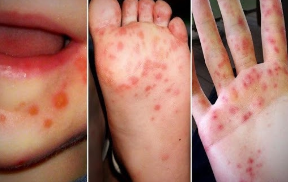 Hướng dẫn cách phòng ngừa bệnh tay chân miệng ở trẻ em