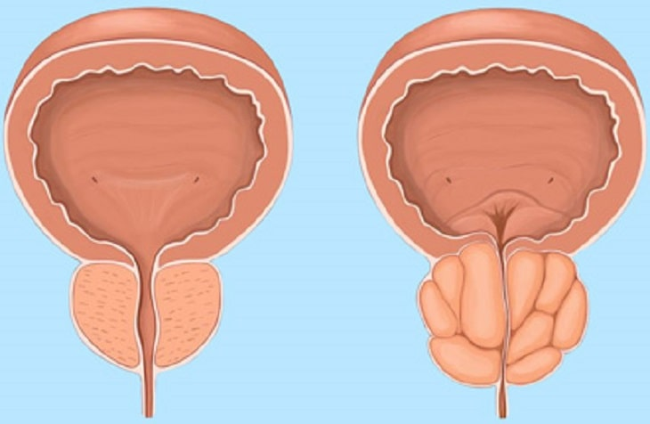 Phì đại tuyến tiền liệt: Nguyên nhân, triệu chứng và cách điều trị