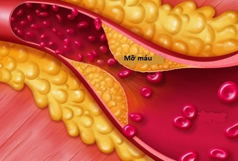 Rối loạn chuyển hóa lipid máu có thể dẫn đến xơ vữa động mạch.