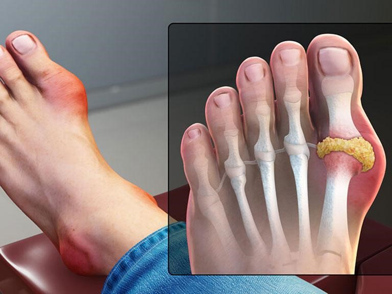 Bệnh gút: Nguyên nhân, triệu chứng và cách điều trị
