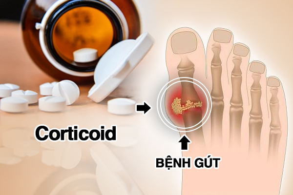 Corticoid giúp giảm đau, sưng viêm trong các cơn gút cấp