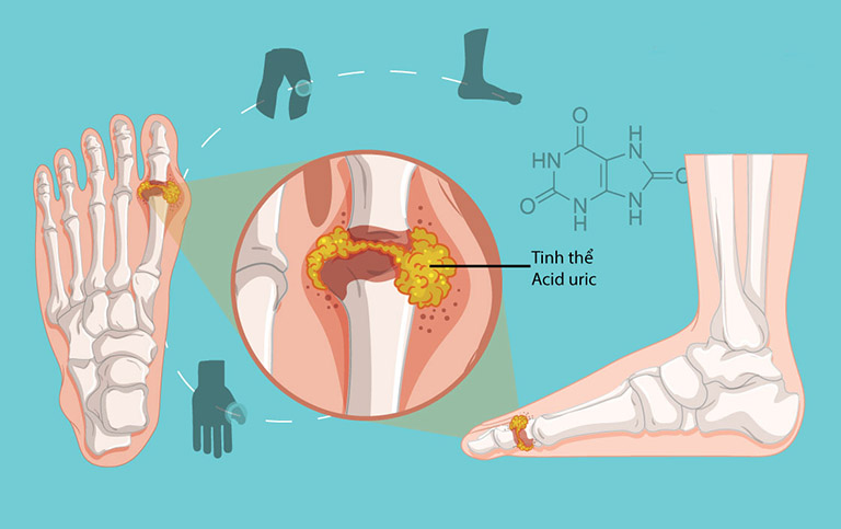  Tăng acid uric máu là nguyên nhân gây ra bệnh gút