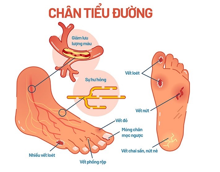 Nhiễm trùng gây ra biến chứng bàn chân tiểu đường