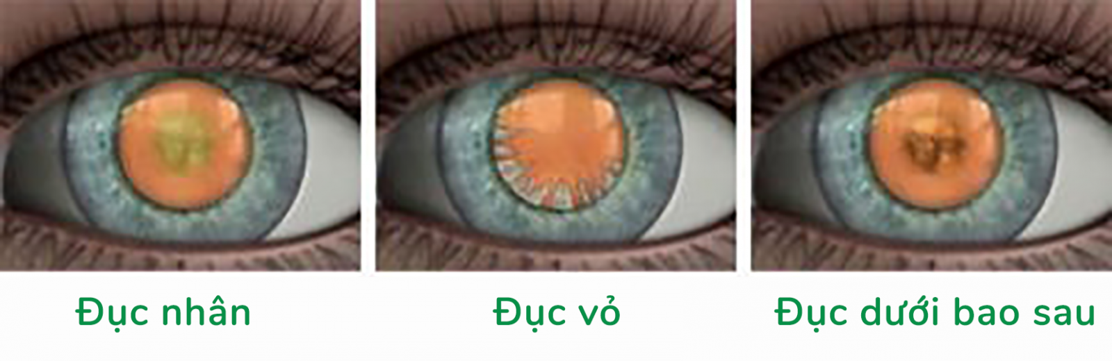 3 loại đục thủy tinh thể theo hình thái, vị trí