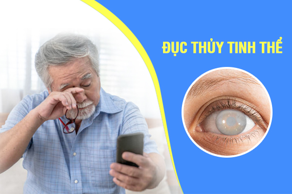 Đục thủy tinh thể: Nguyên nhân, triệu chứng và các phương pháp điều trị