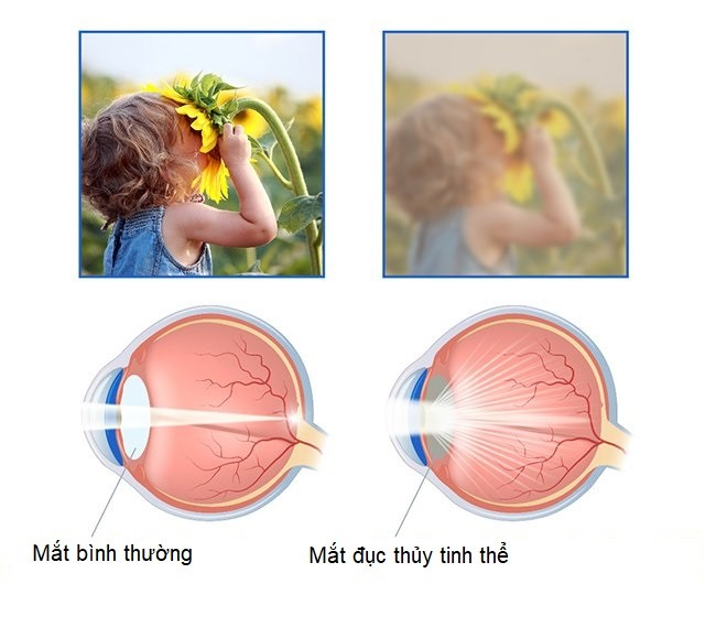 Hình ảnh nhìn từ mắt bị đục thủy tinh thể