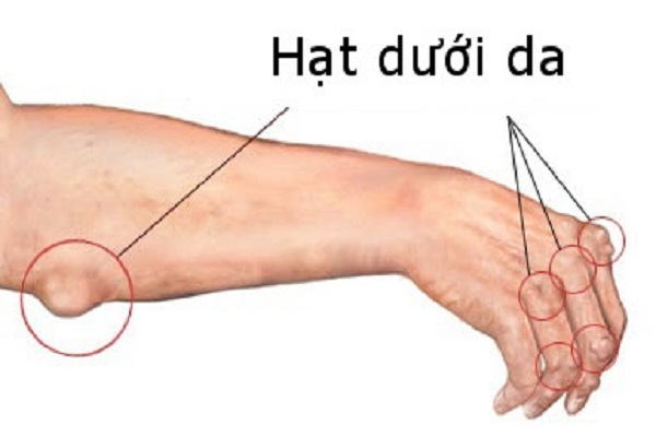 Hạt dạng thấp dưới da