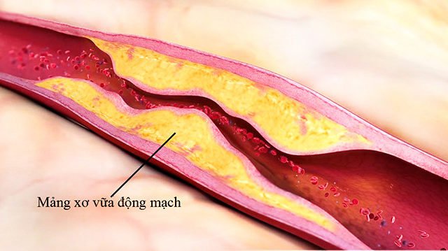  Xơ vữa động mạch làm tăng huyết áp ở người bệnh tiểu đường