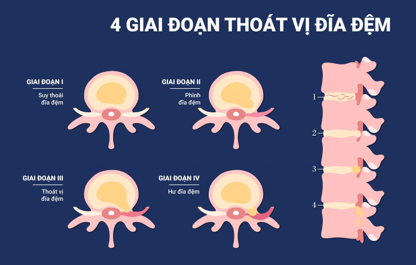Các giai đoạn thoát vị đĩa đệm