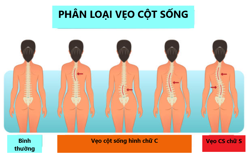 Minh họa các loại vẹo cột sống