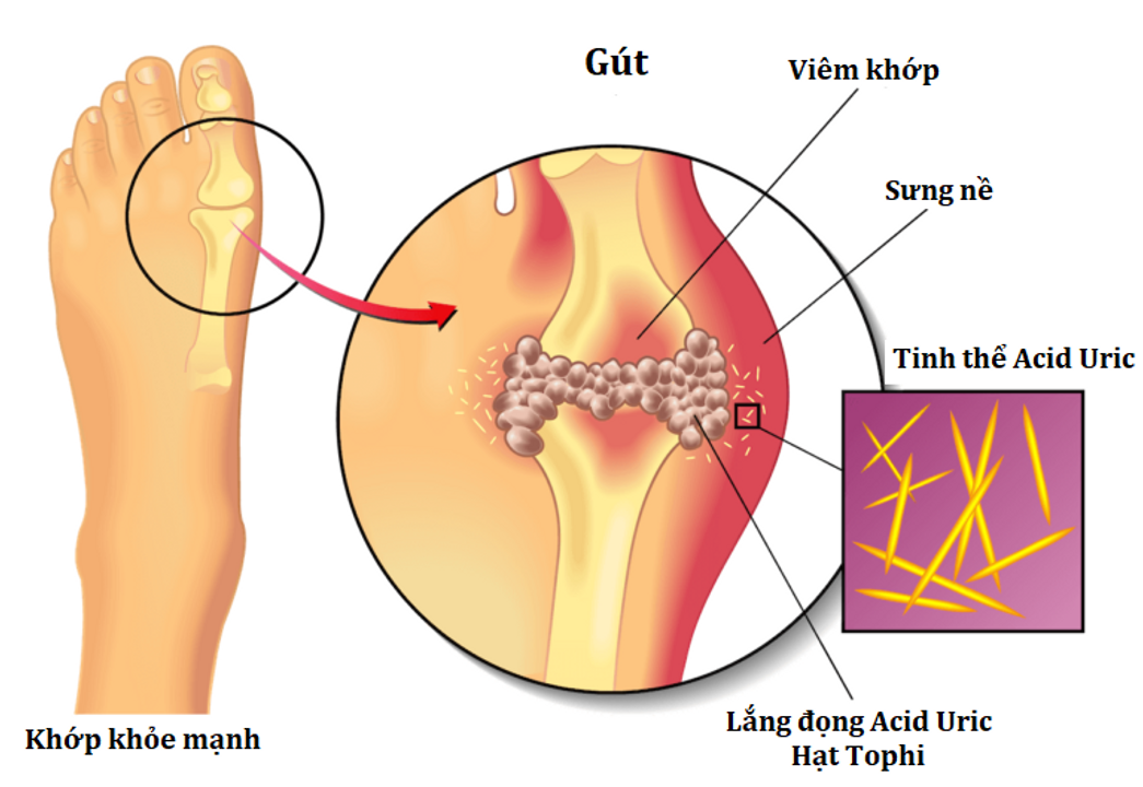 Soi dịch hạt tophi sẽ có tinh thể muối urat