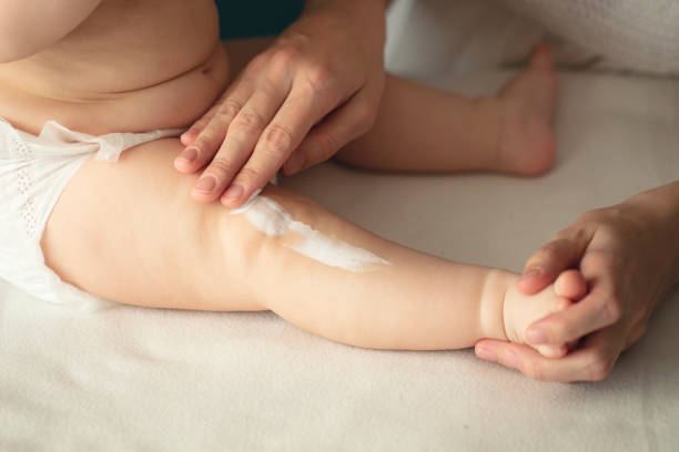 Nhiều phụ huynh tìm hiểu trên mạng rồi tự mua thuốc về bôi cho con