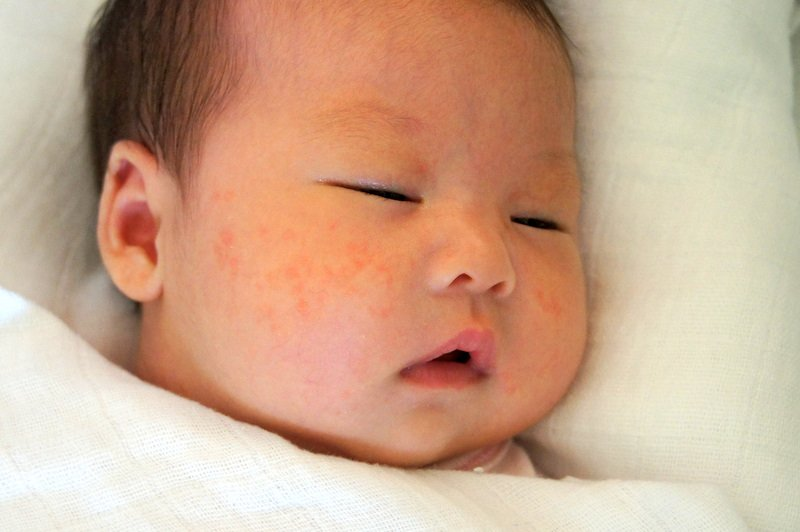 Cần lưu ý các dấu hiệu bệnh sởi ở trẻ.