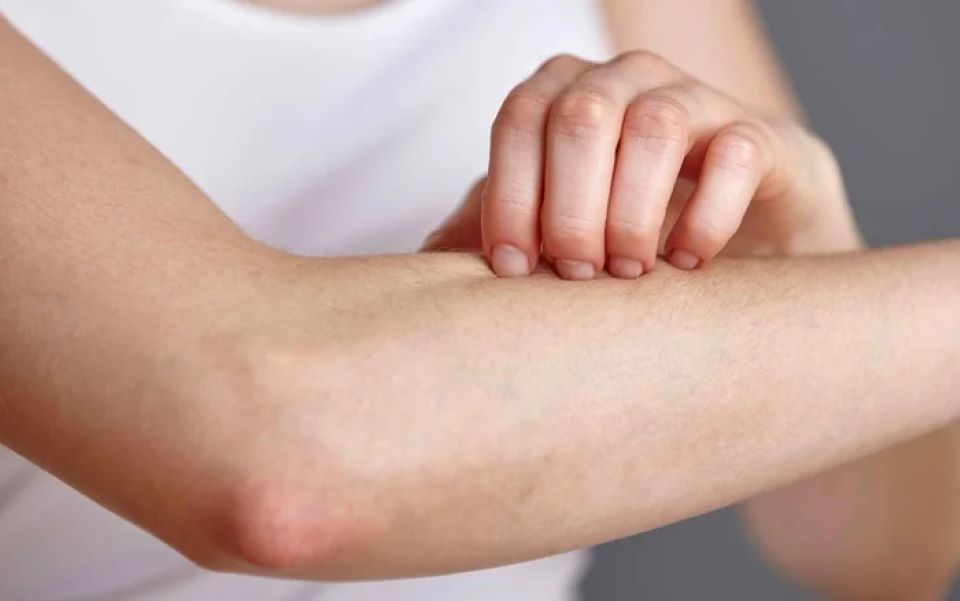 Thời tiết nồm ẩm khiến mọi người dễ mắc các bệnh về da.