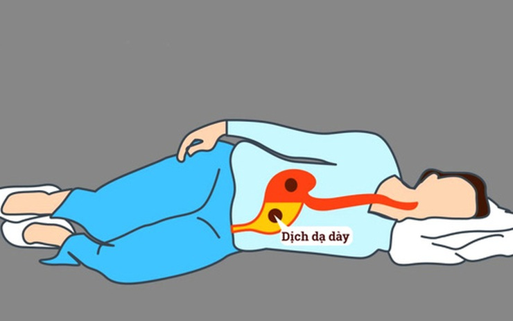 Nằm ngay sau ăn khiến dịch dạ dày bị trào ngược hơn.