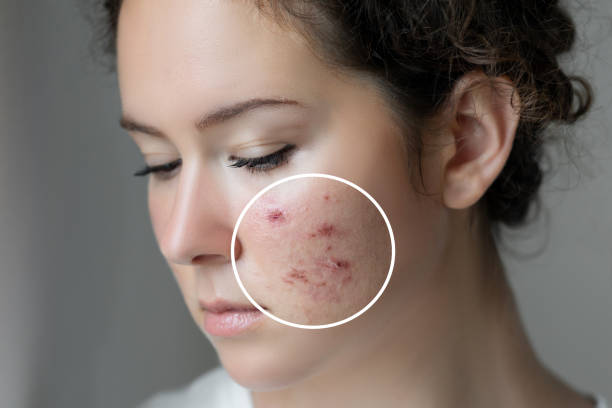 Nếu không trị mụn đúng cách, bạn dễ gặp biến chứng sẹo lồi, sẹo thâm