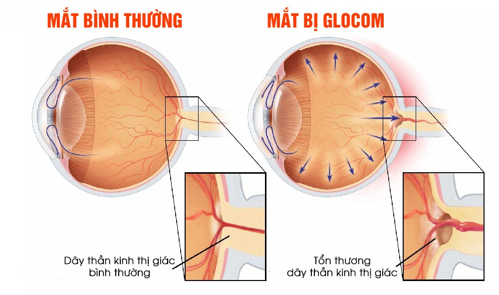 Minh họa mắt bình thường và mắt bị glocom.