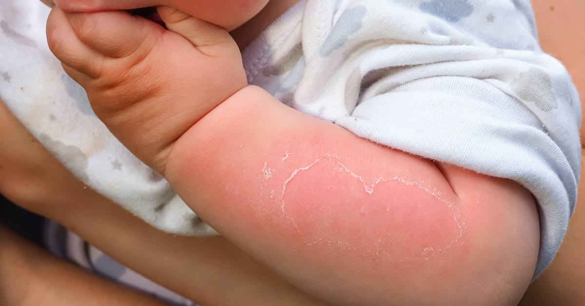 Trẻ bị bỏng suýt gặp họa vì gia đình ngâm trong thùng nước đưa đến viện