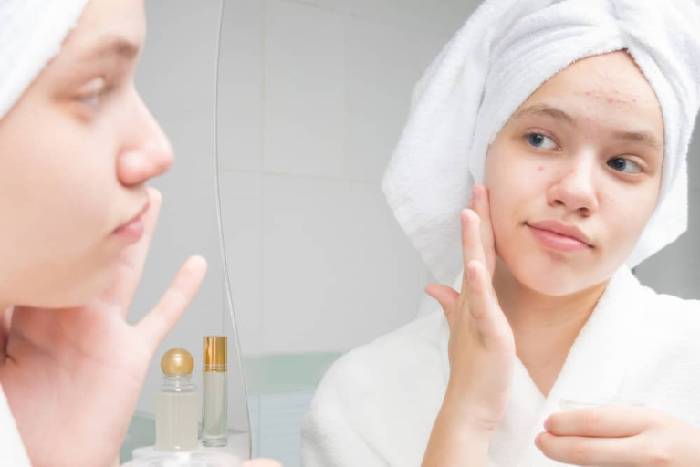 Trà sữa là một nguyên nhân khiến da bạn nổi mụn.