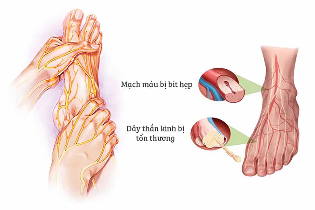 Bệnh lý thần kinh tiểu đường là rối loạn thần kinh có mức độ gia tăng nhanh nhất.