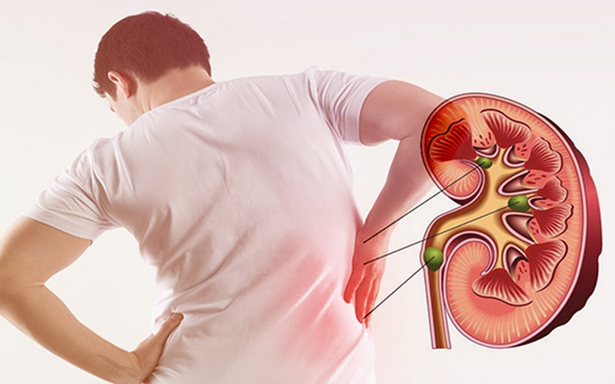 Sỏi thận ảnh hưởng đến sức khỏe sinh lý nam giới thế nào?