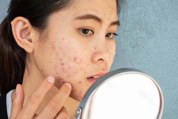 Người phụ nữ mọc mụn sưng viêm