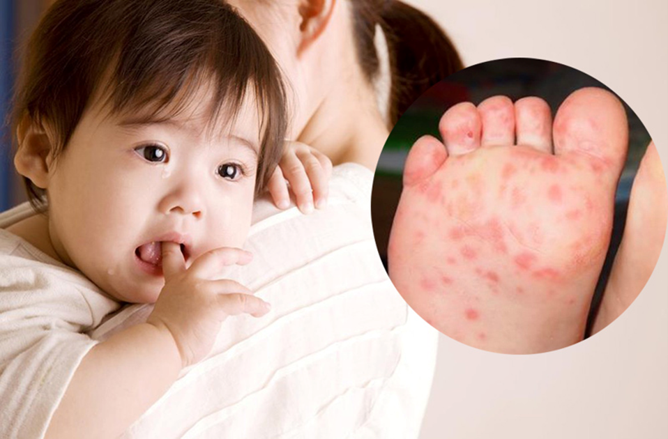 Số trẻ mắc tay chân miệng tiếp tục tăng tại Hà Nội.