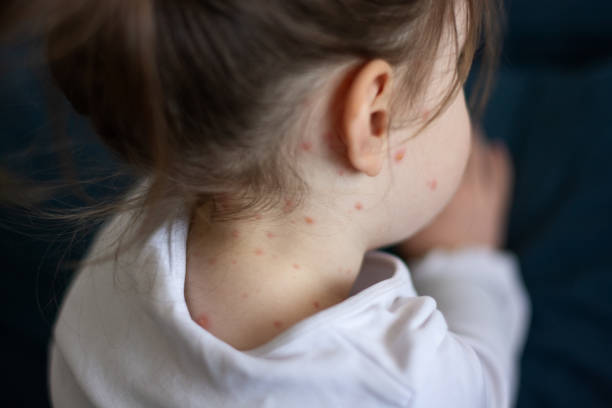 Phát ban là triệu chứng thường gặp của Rubella