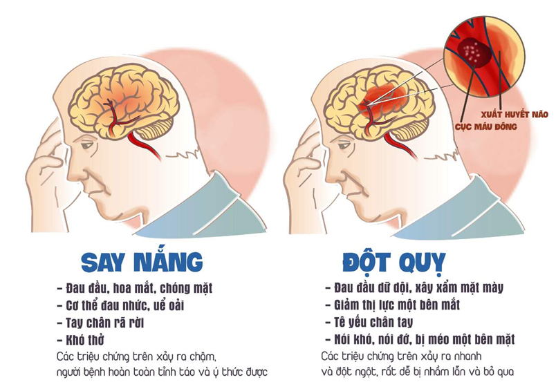 Phân biệt say nắng và đột quỵ do nắng nóng.