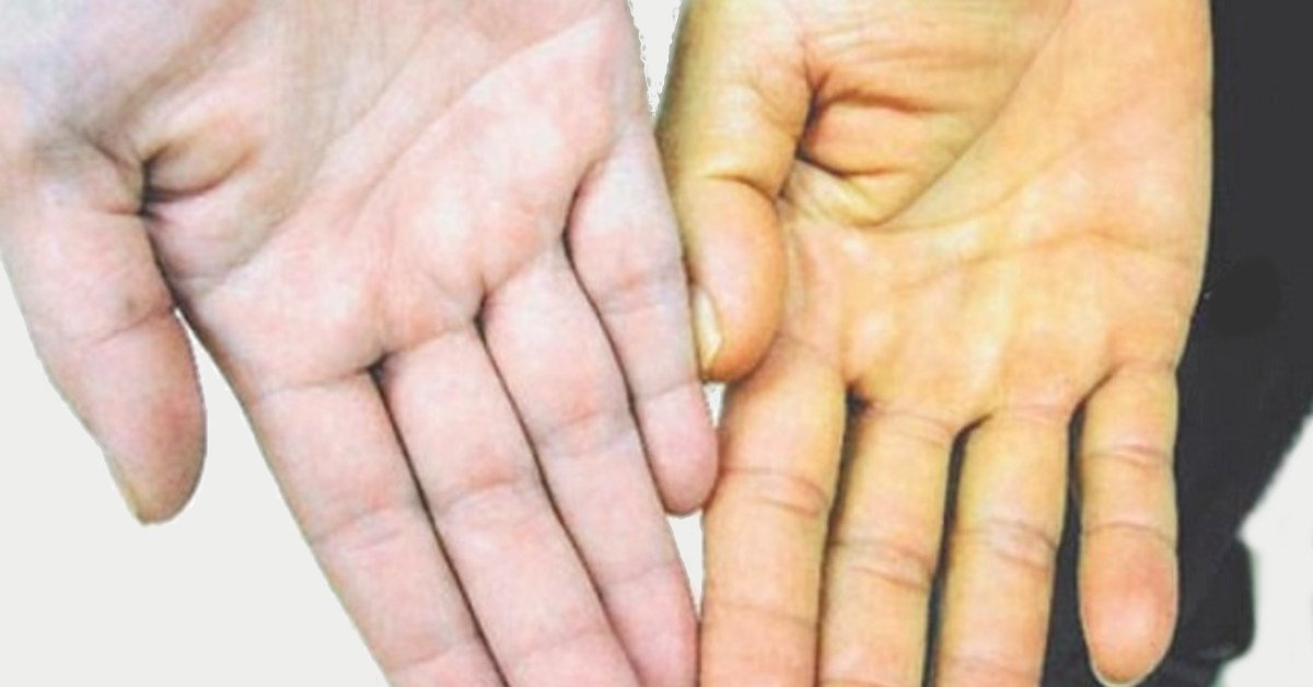 Triệu chứng vàng da ở bệnh nhân viêm gan B.