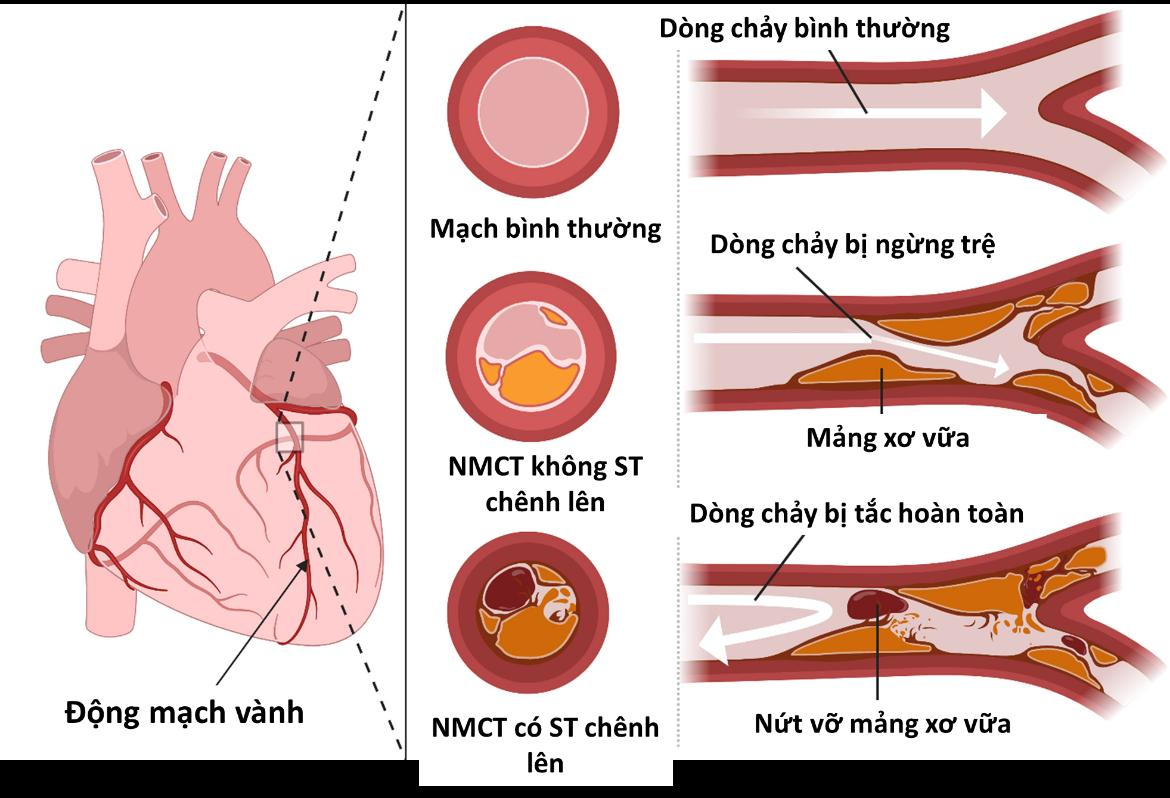 Các mảng xơ vữa trong động mạch cản trở dòng máu lưu thông.