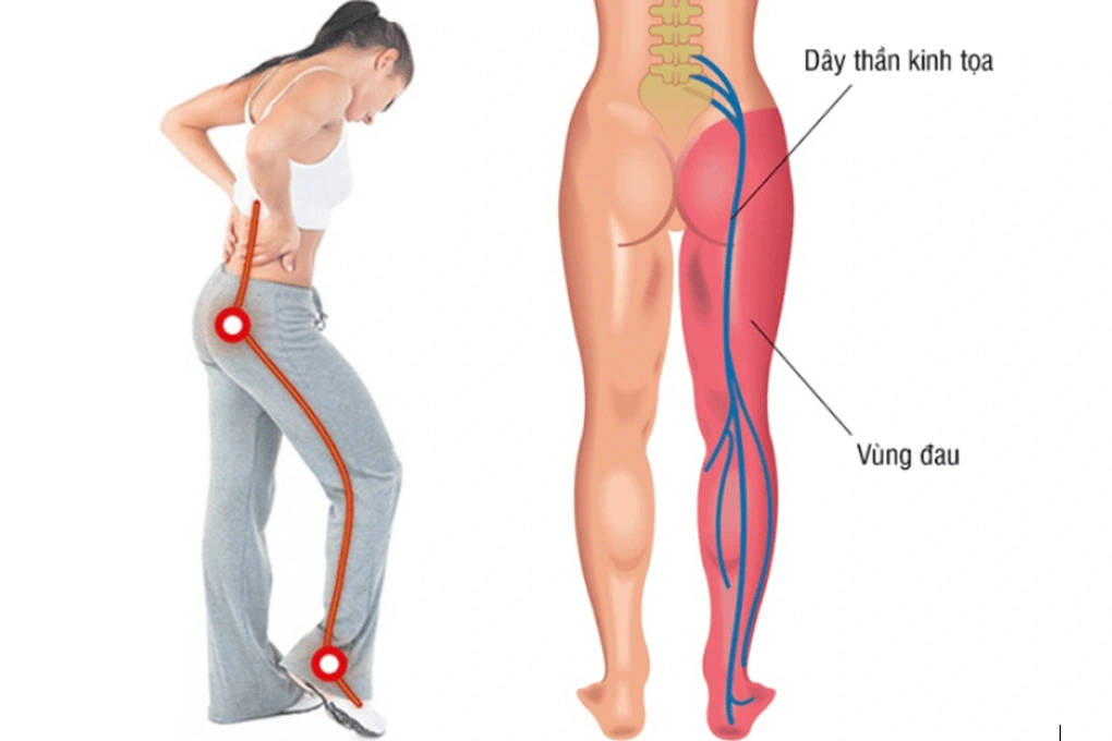 Đau thần kinh tọa ngày càng trẻ hóa: Nguyên nhân do đâu?